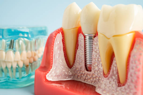 Best Wisdom Tooth Removal  in Rockwell Place, TX